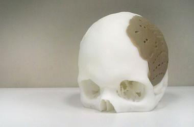 replacement implants skull